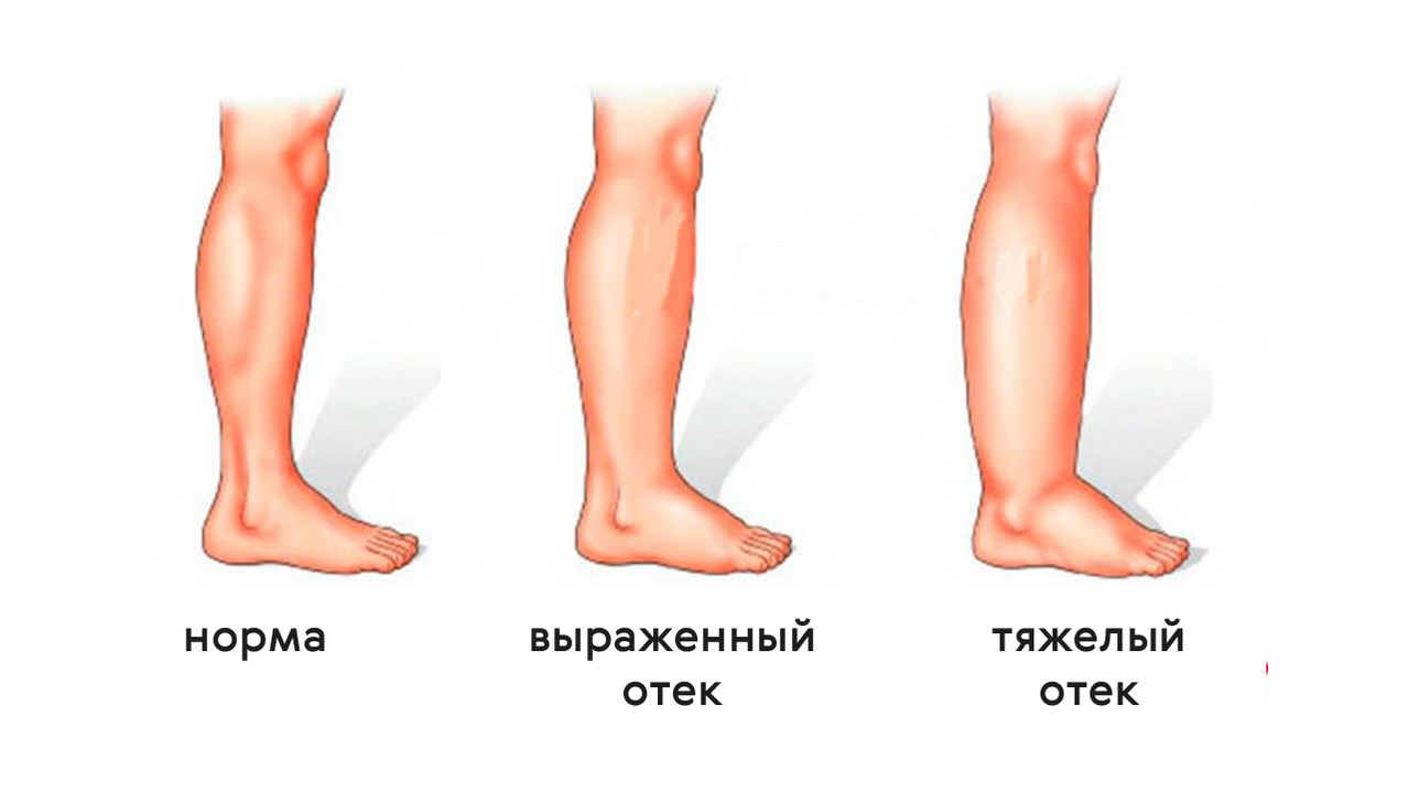почему у алкоголиков болят ноги почему у алкоголиков болят ноги