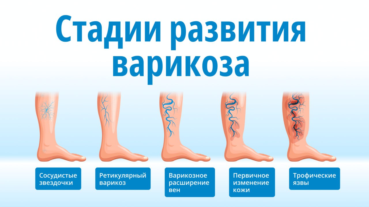 питание при варикозе нижних конечностей