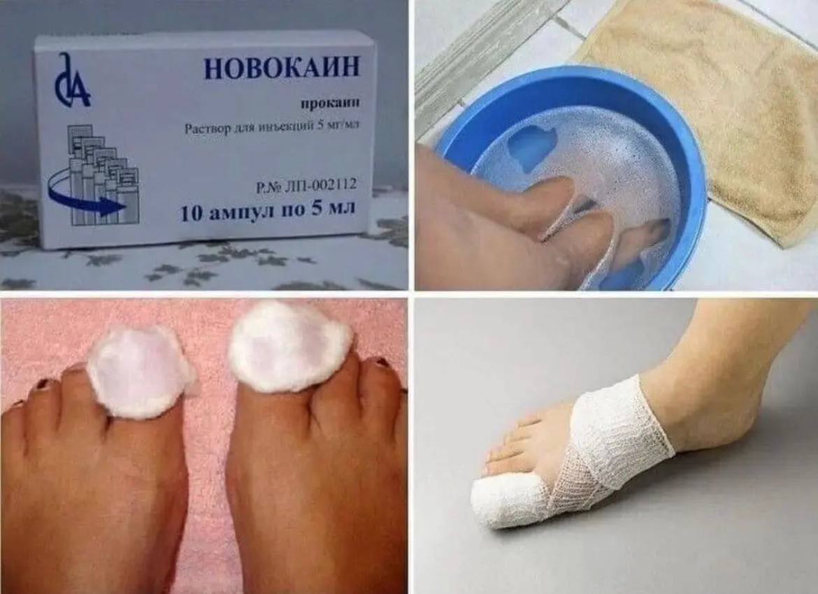 удаление грибка ногтей лазером отзывы удаление грибка ногтей лазером отзывы