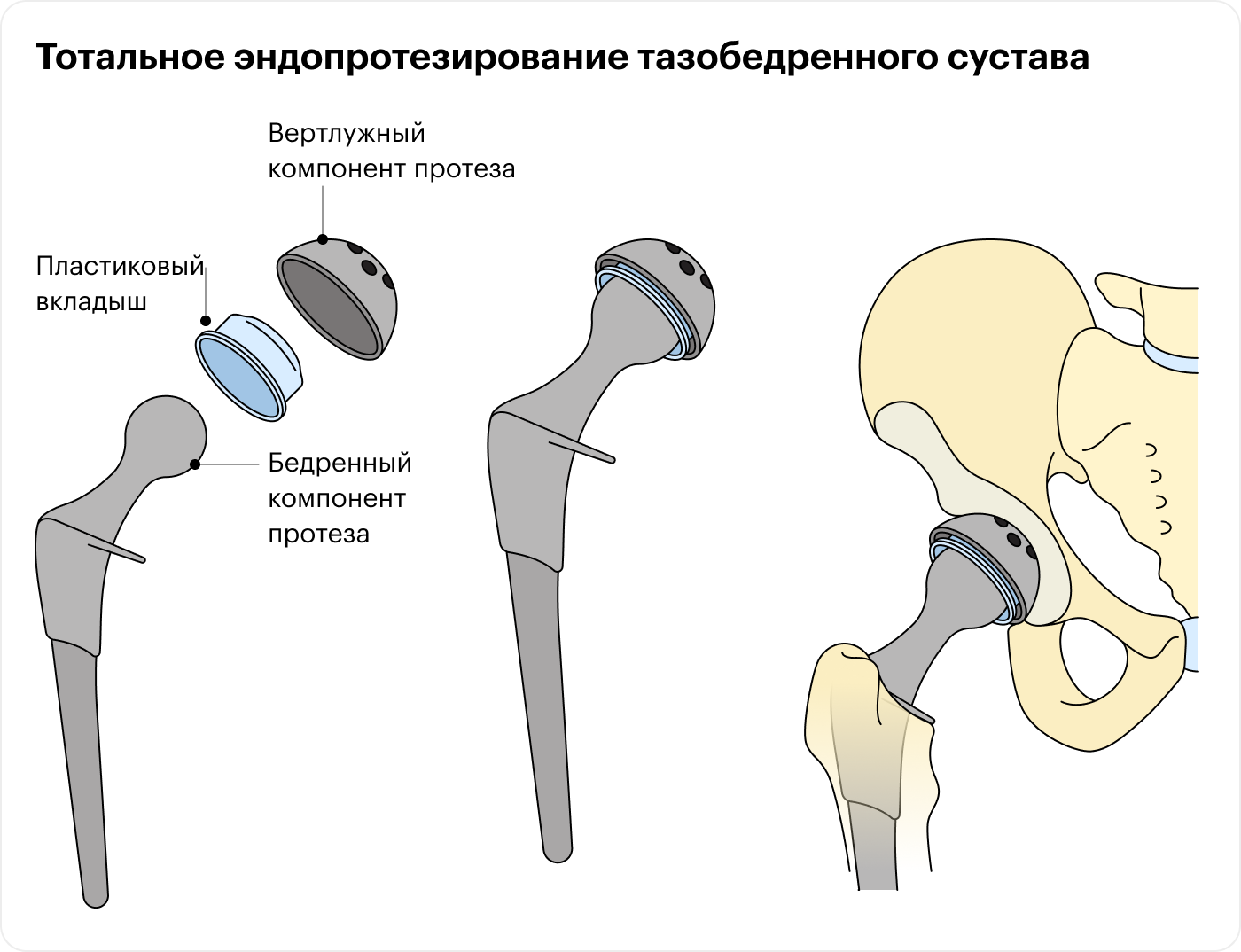 первые дни после эндопротезирования тазобедренного сустава первые дни после эндопротезирования тазобедренного сустава