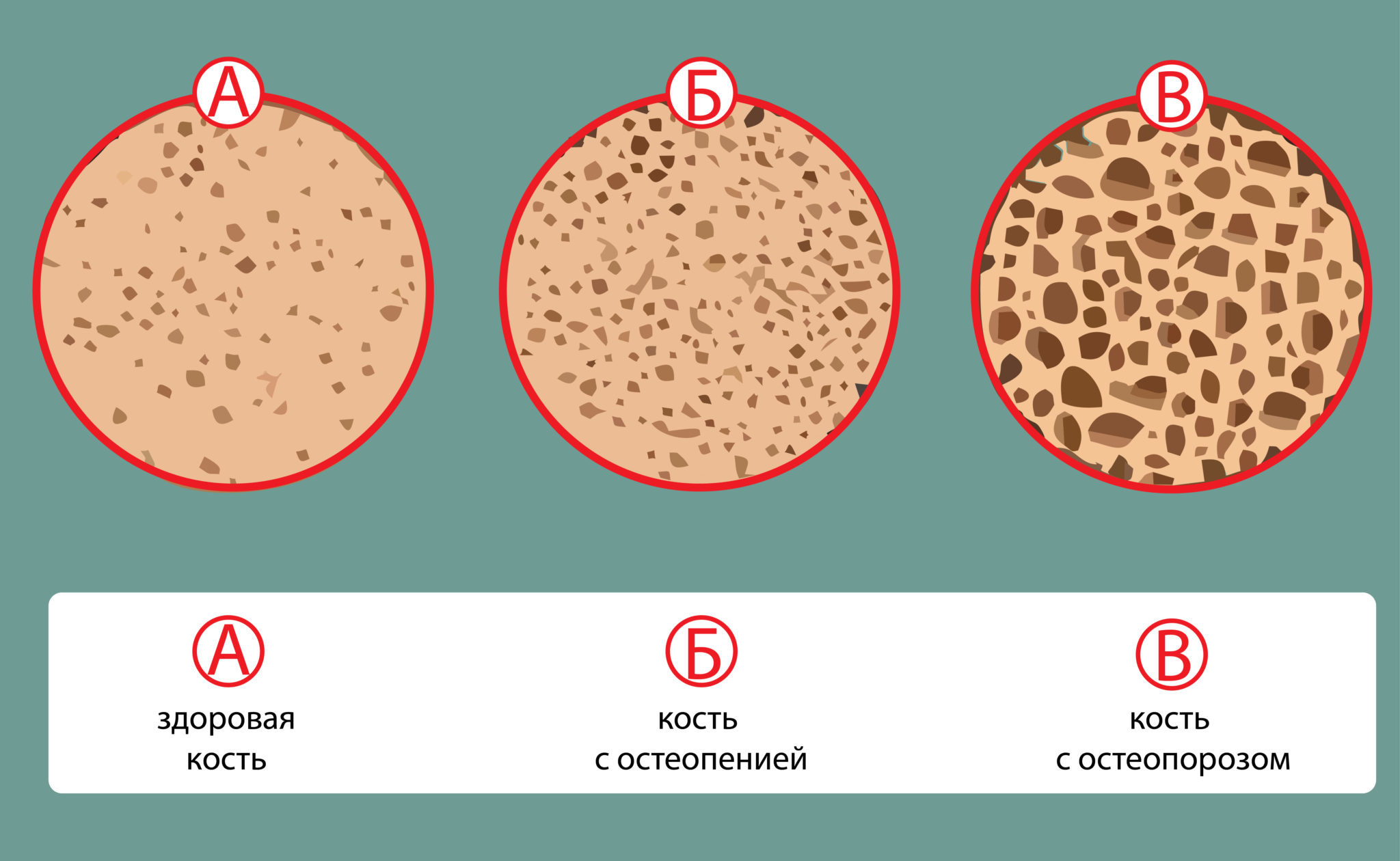 порозность кости это