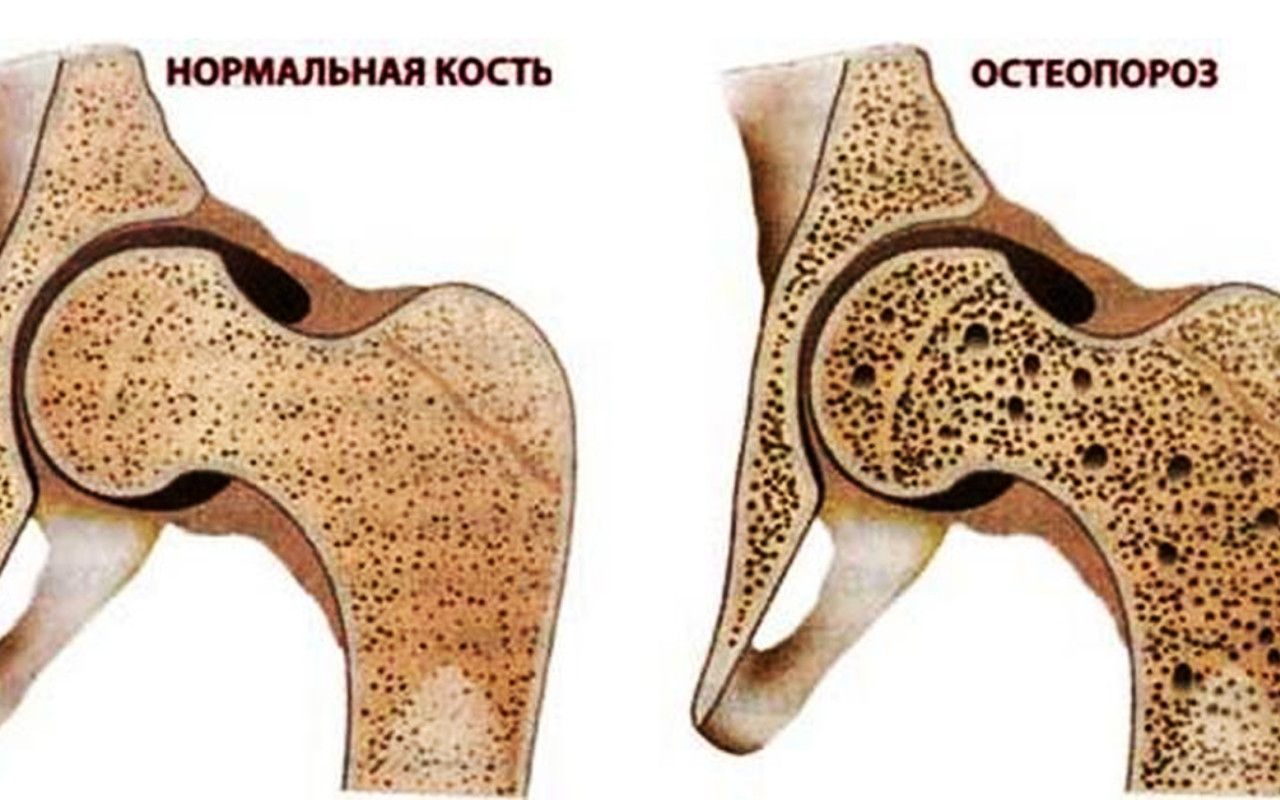 порозность кости это