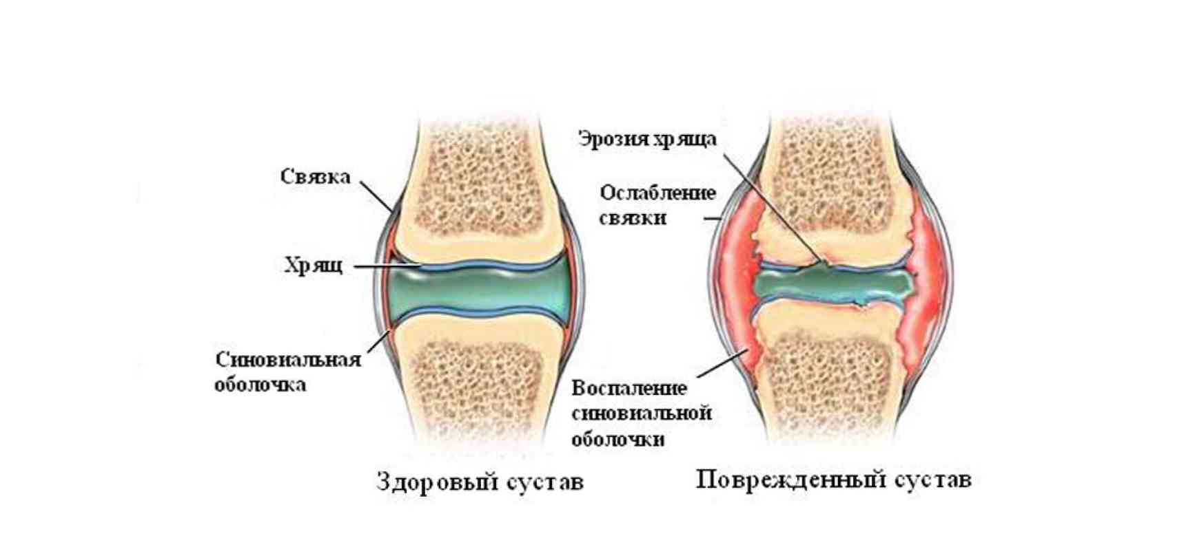 признаки скопления жидкости в коленном суставе