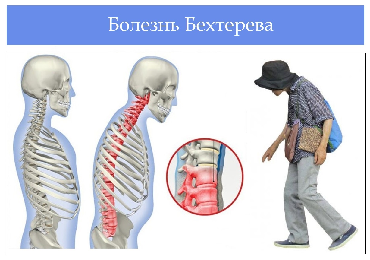 болезнь бехтерева что это такое у женщин симптомы и лечение