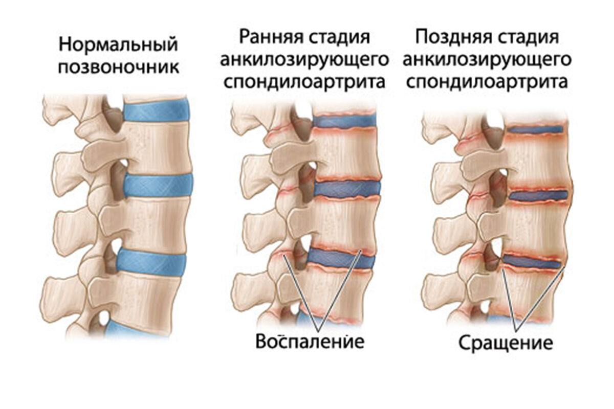 болезнь бехтерева что это такое у женщин симптомы и лечение