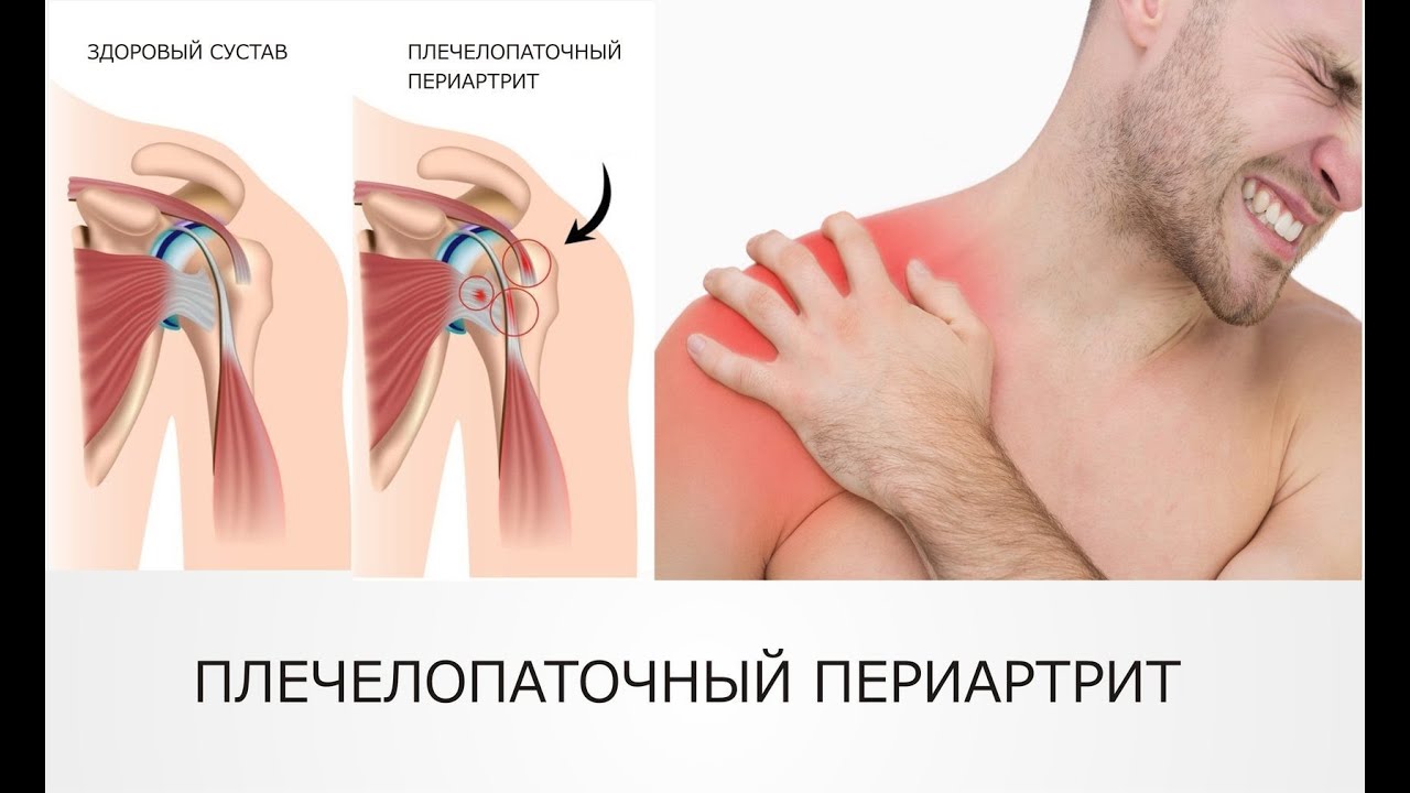 болит плечо не поднимается рука лечение