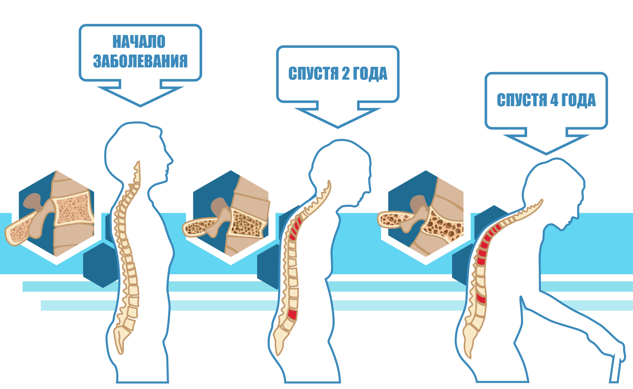 как предупредить остеопороз