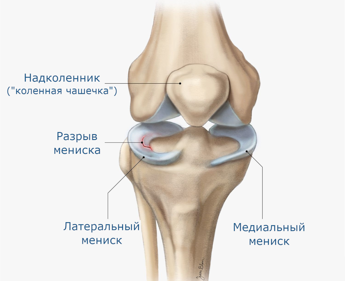 мениска заболевание мениска заболевание