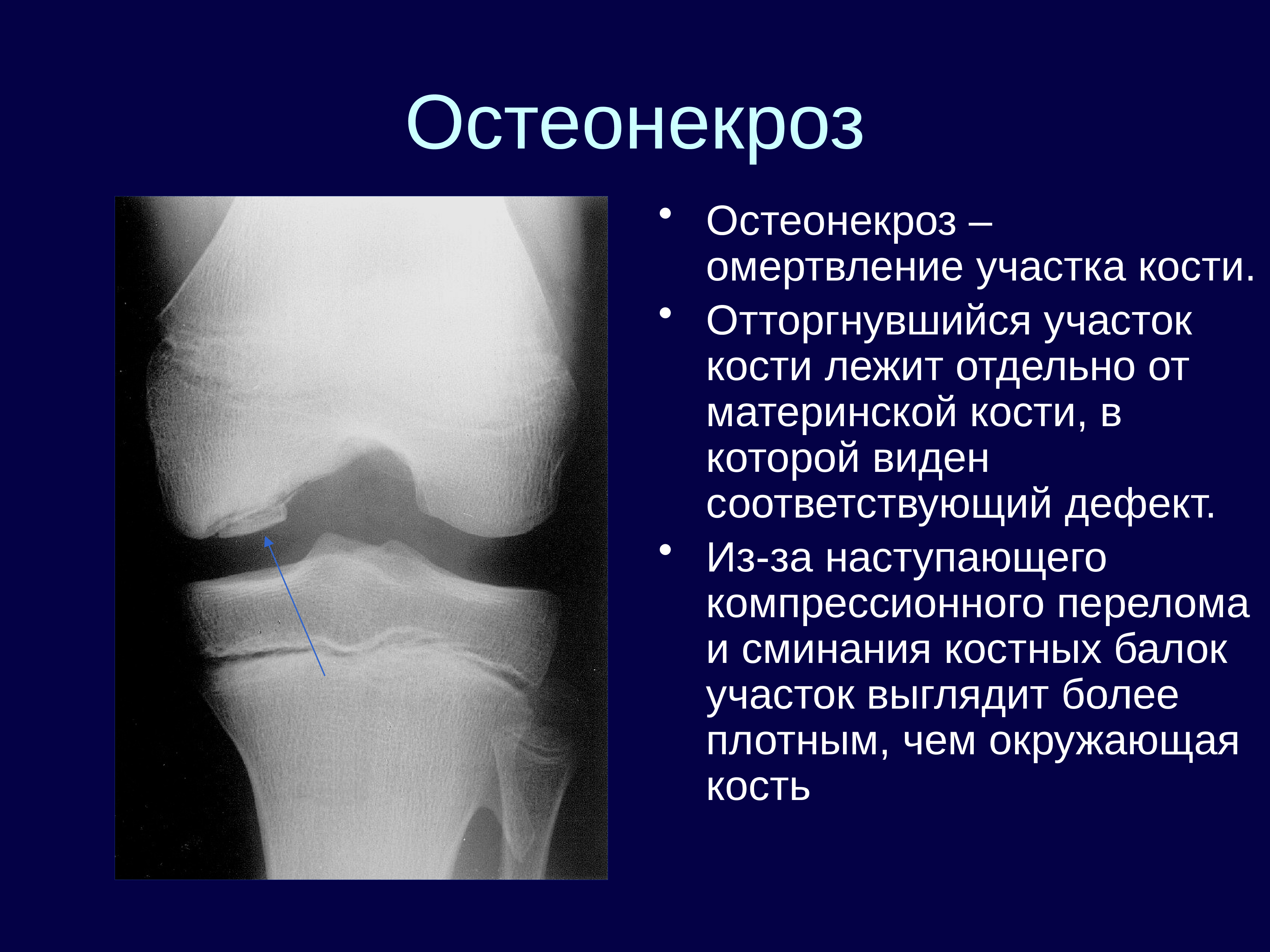 остеохондропатия келлера