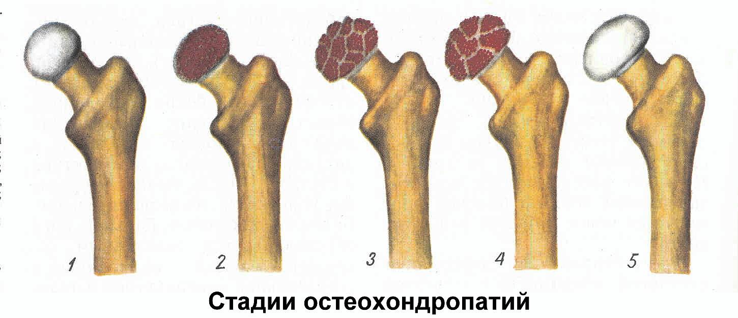 остеохондропатия келлера