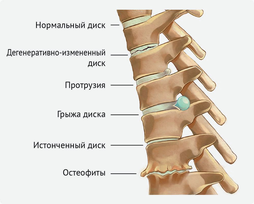 остеохондроз симптомы и признаки болезни остеохондроз симптомы и признаки болезни