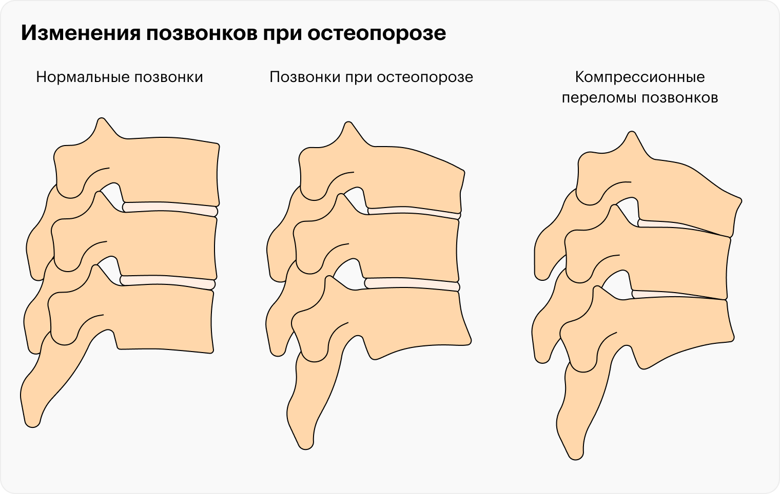 остеопения лечение препараты