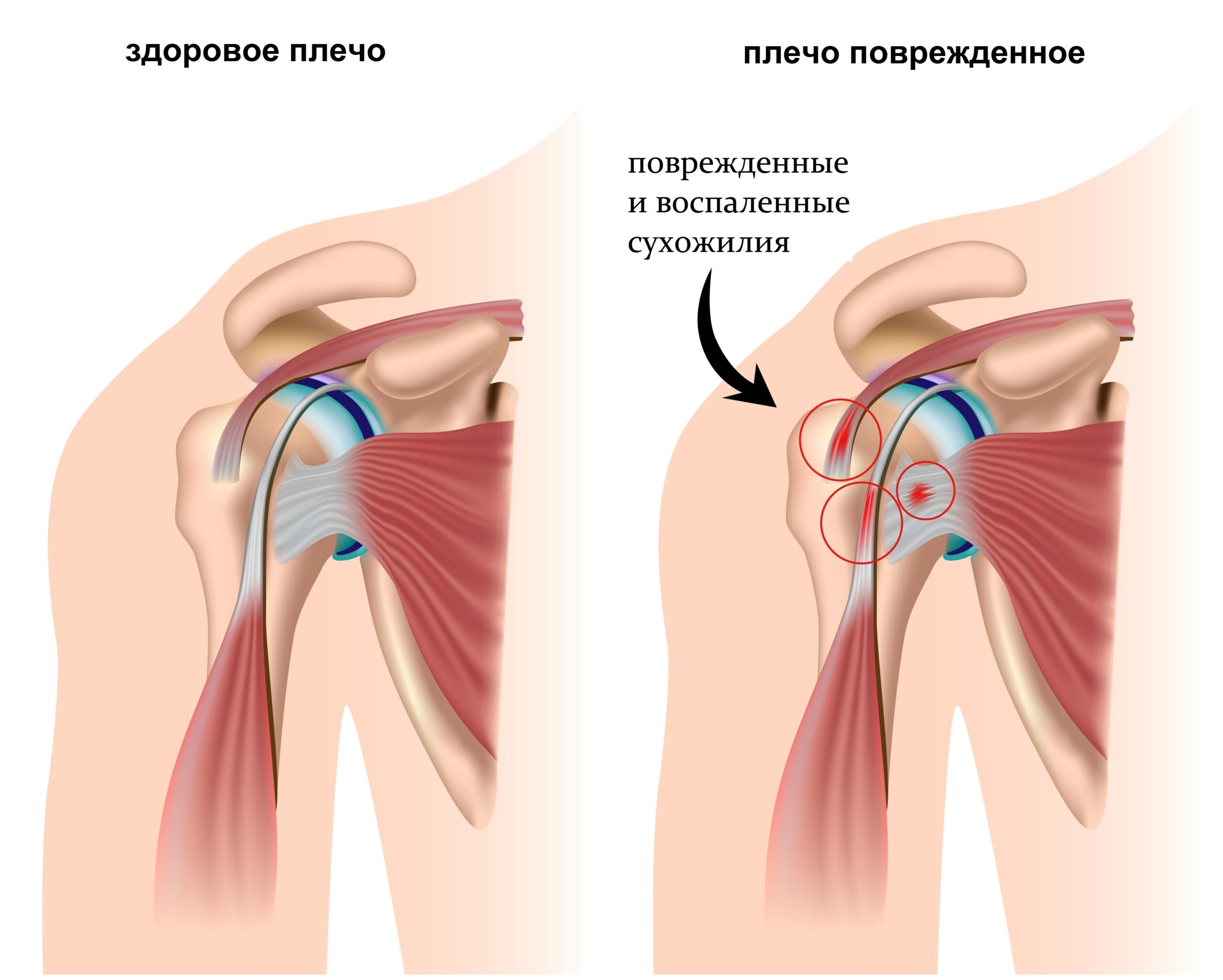 периартрит плечелопаточный справа
