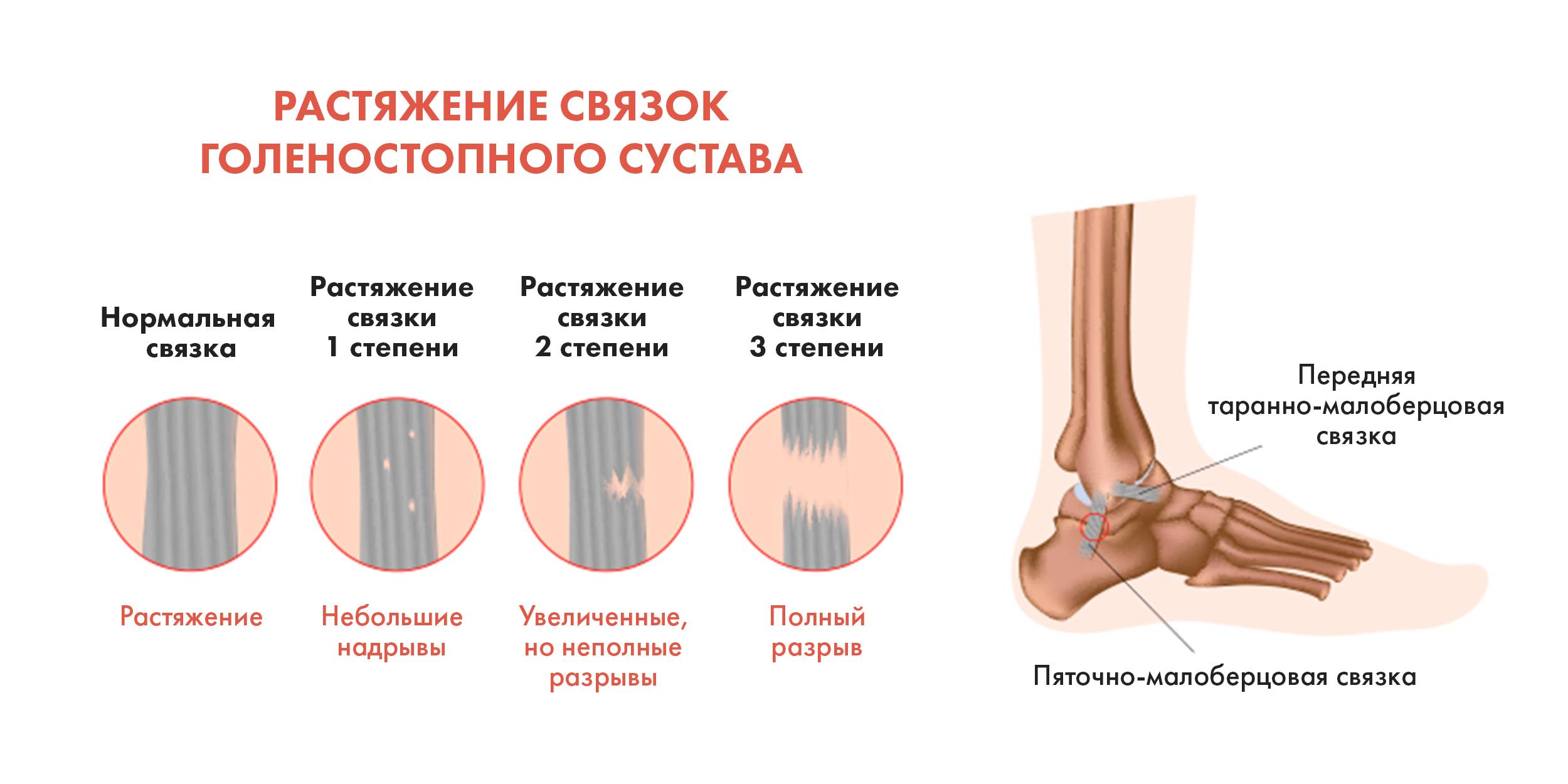 потянул связки колена симптомы потянул связки колена симптомы