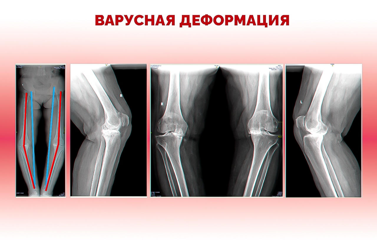 правосторонний гонартроз 1 степени