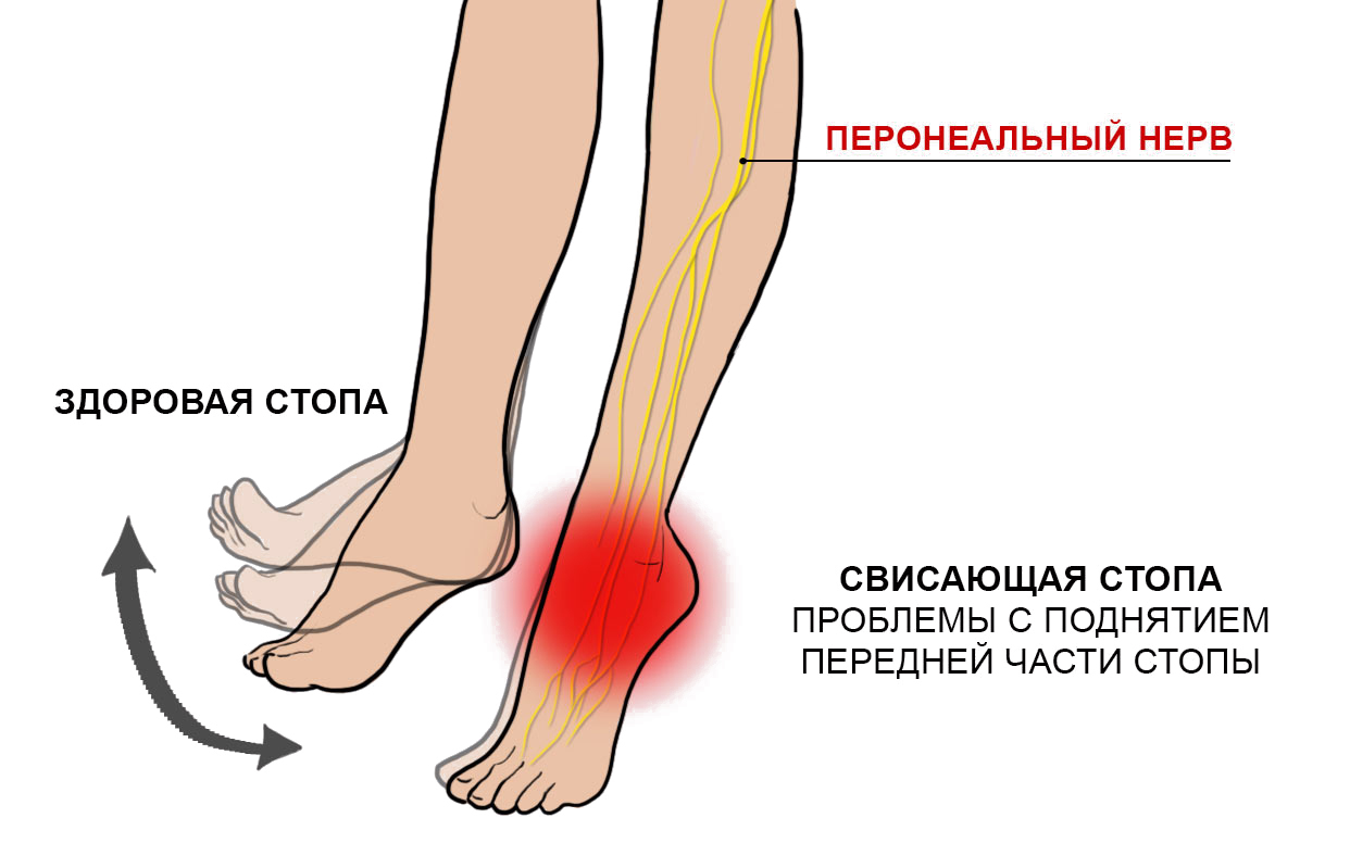 при ходьбе не сгибается колено