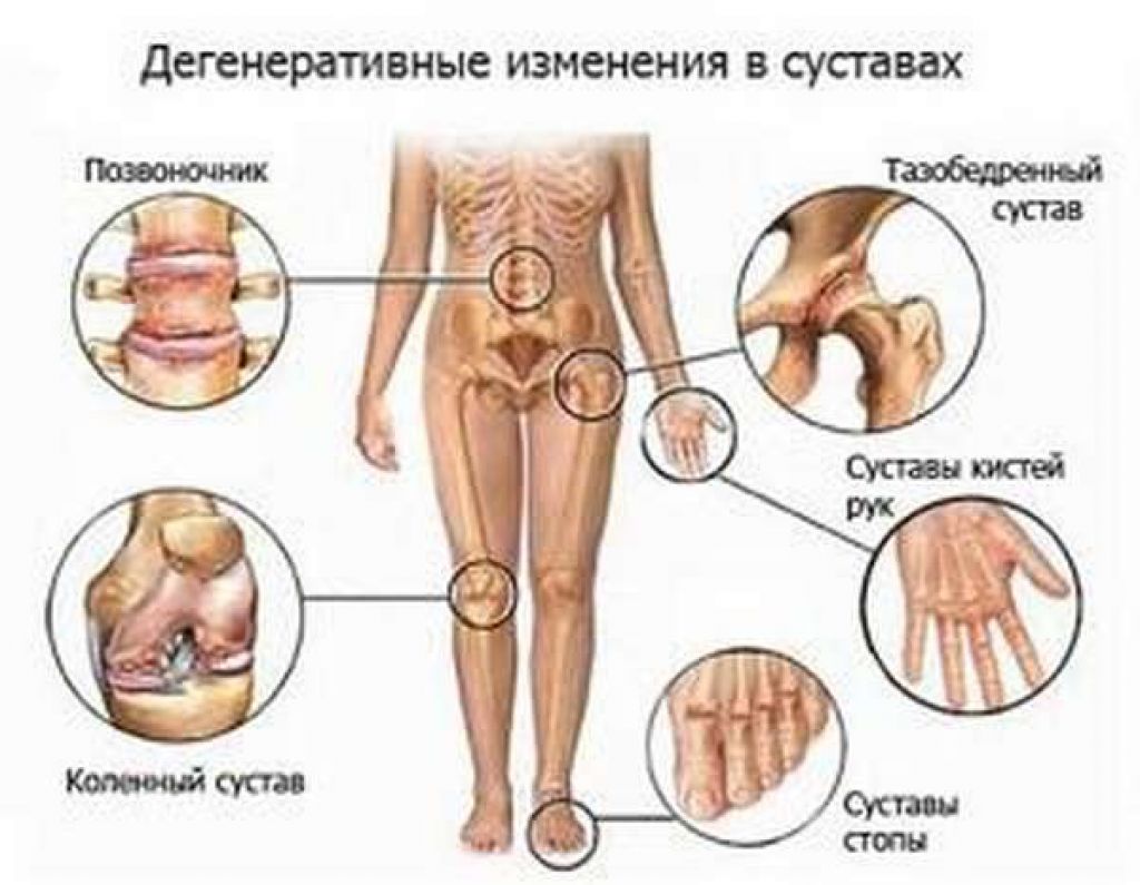 при ревматизме поражаются какие суставы