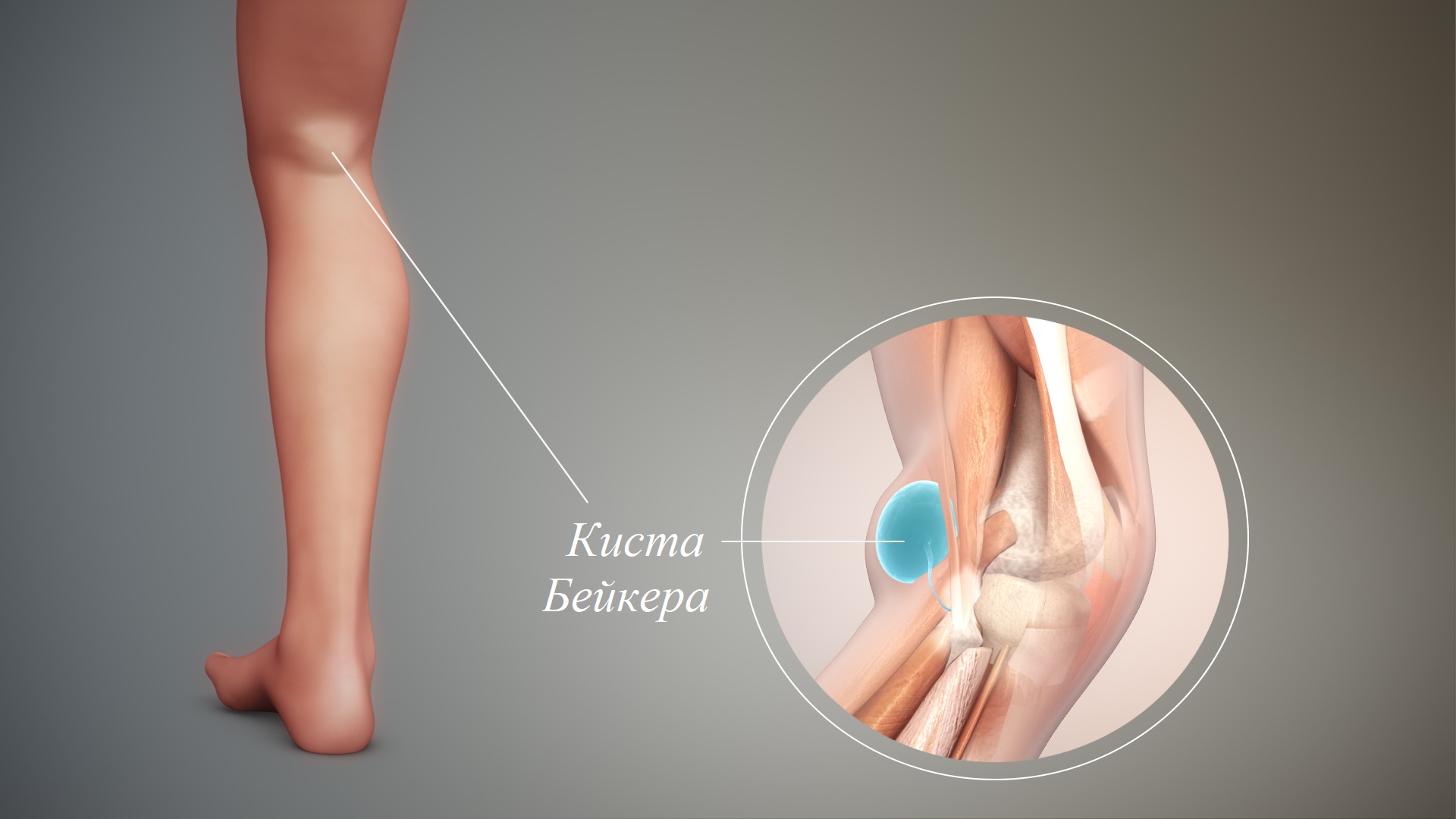 причины боли в подколенной ямке причины боли в подколенной ямке