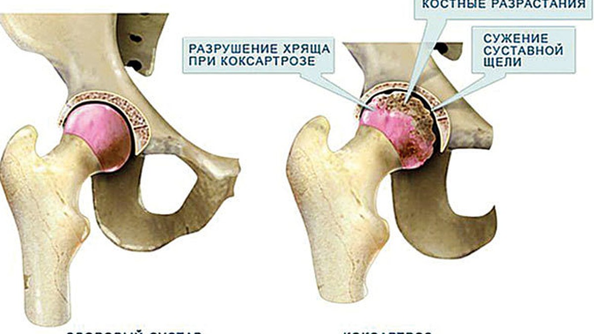 признаки коксартроза тазобедренного сустава 2 степени