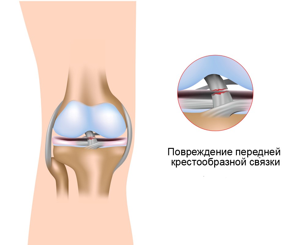 симптомы повреждения пкс