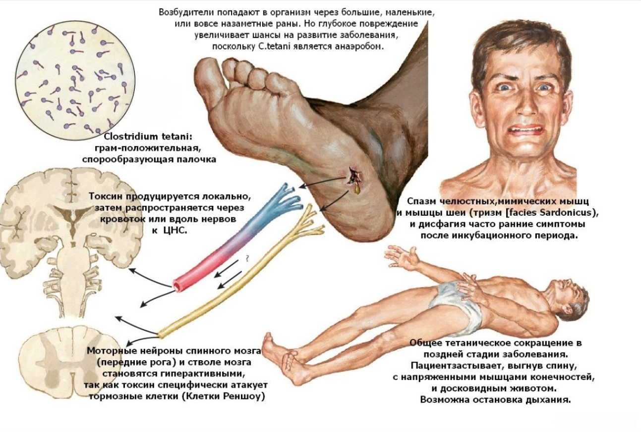 синдром келлера