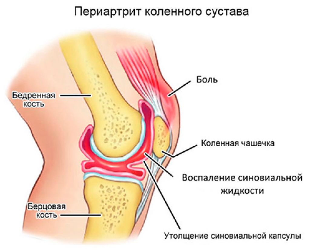 синовита левого коленного сустава