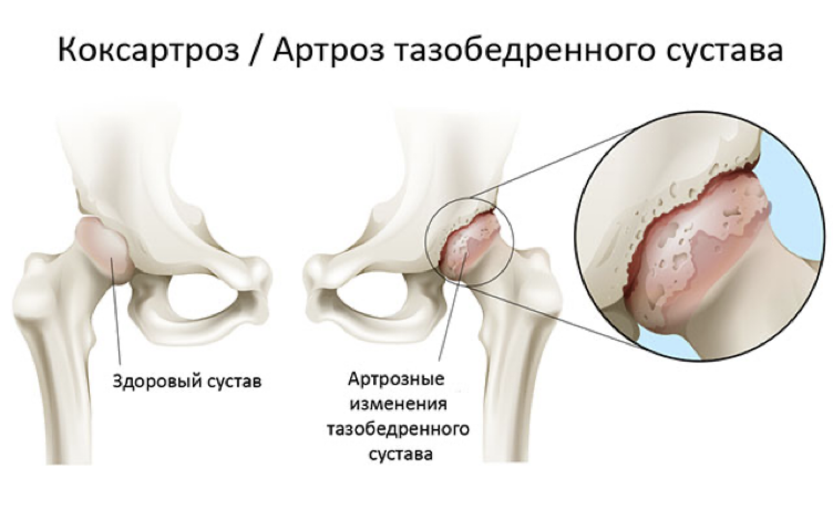 тбс артрит