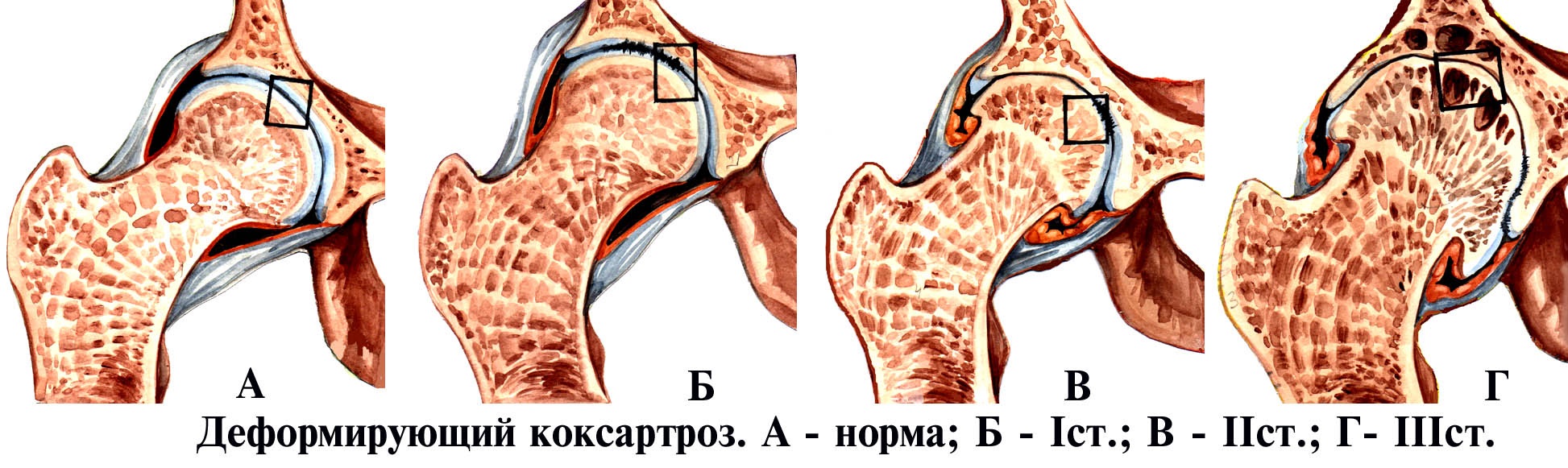 тбс артрит