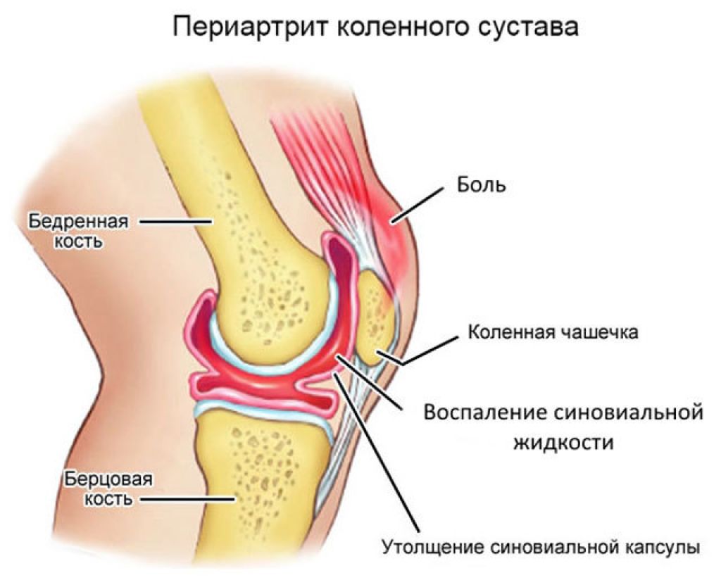в коленке жидкость как лечить
