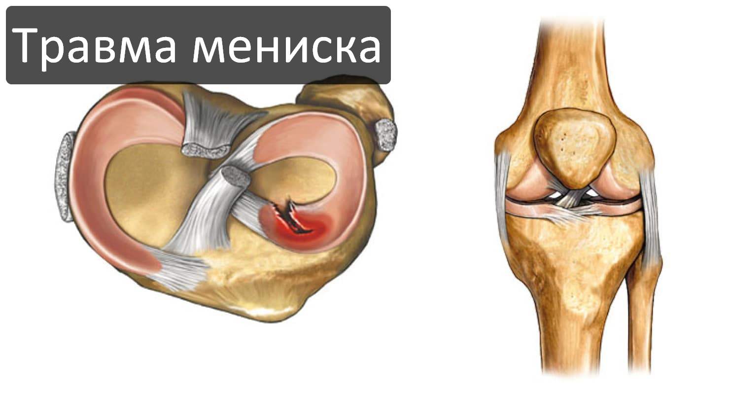 заболела коленка после бега