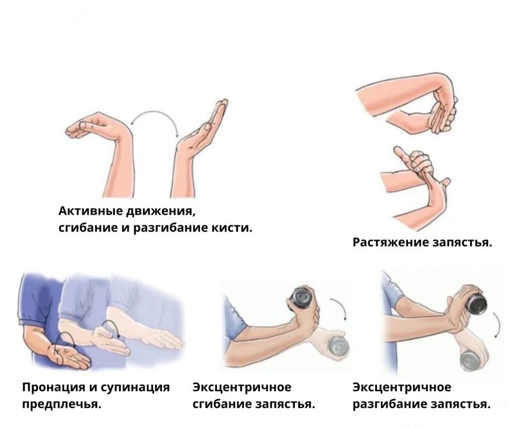 заболевания локтевого сустава эпикондилит