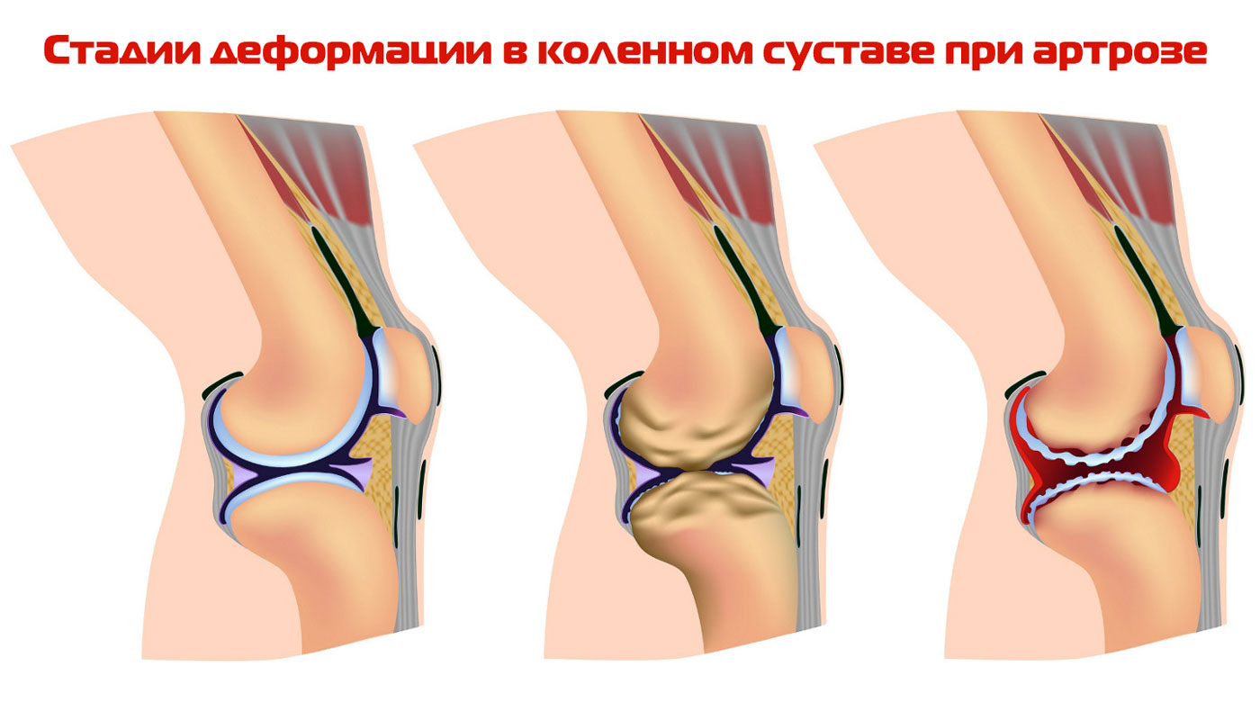 жидкость в коленной чашечке что делать