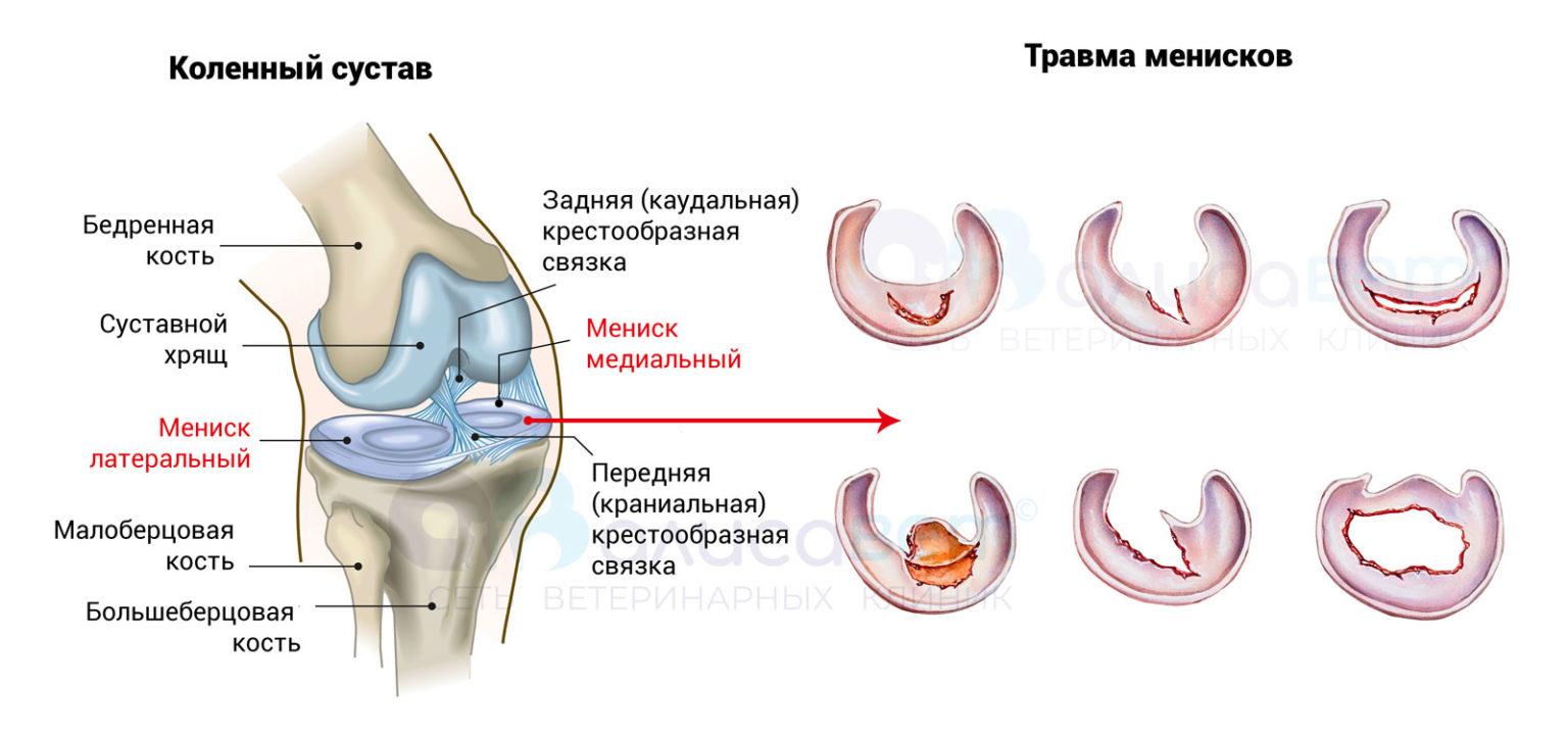 мр картина дегенеративных изменений заднего рога медиального мениска