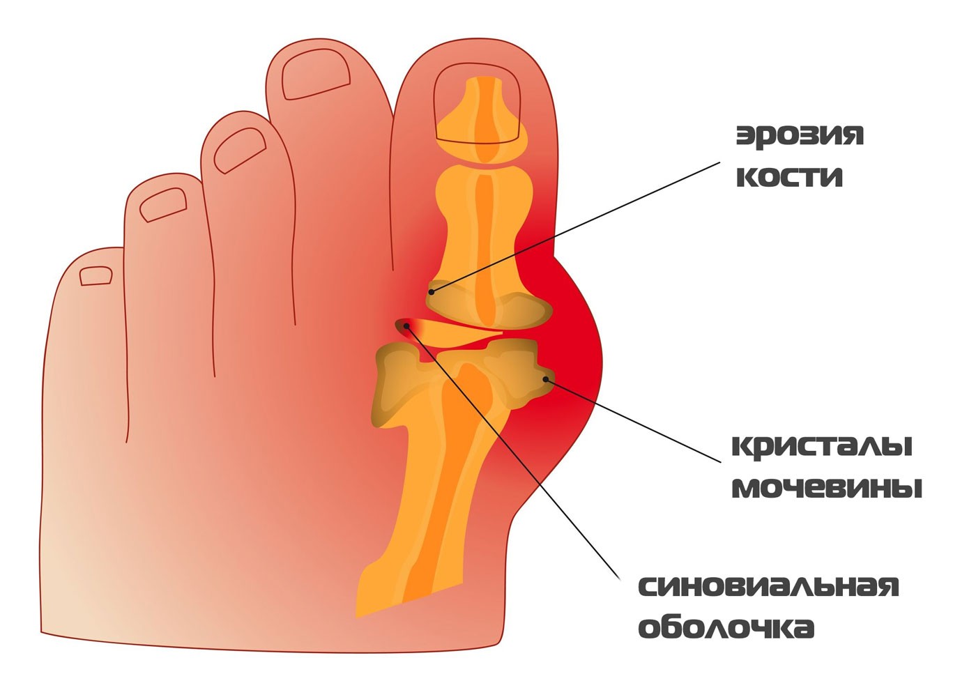 подагра симптомы и лечение народными средствами