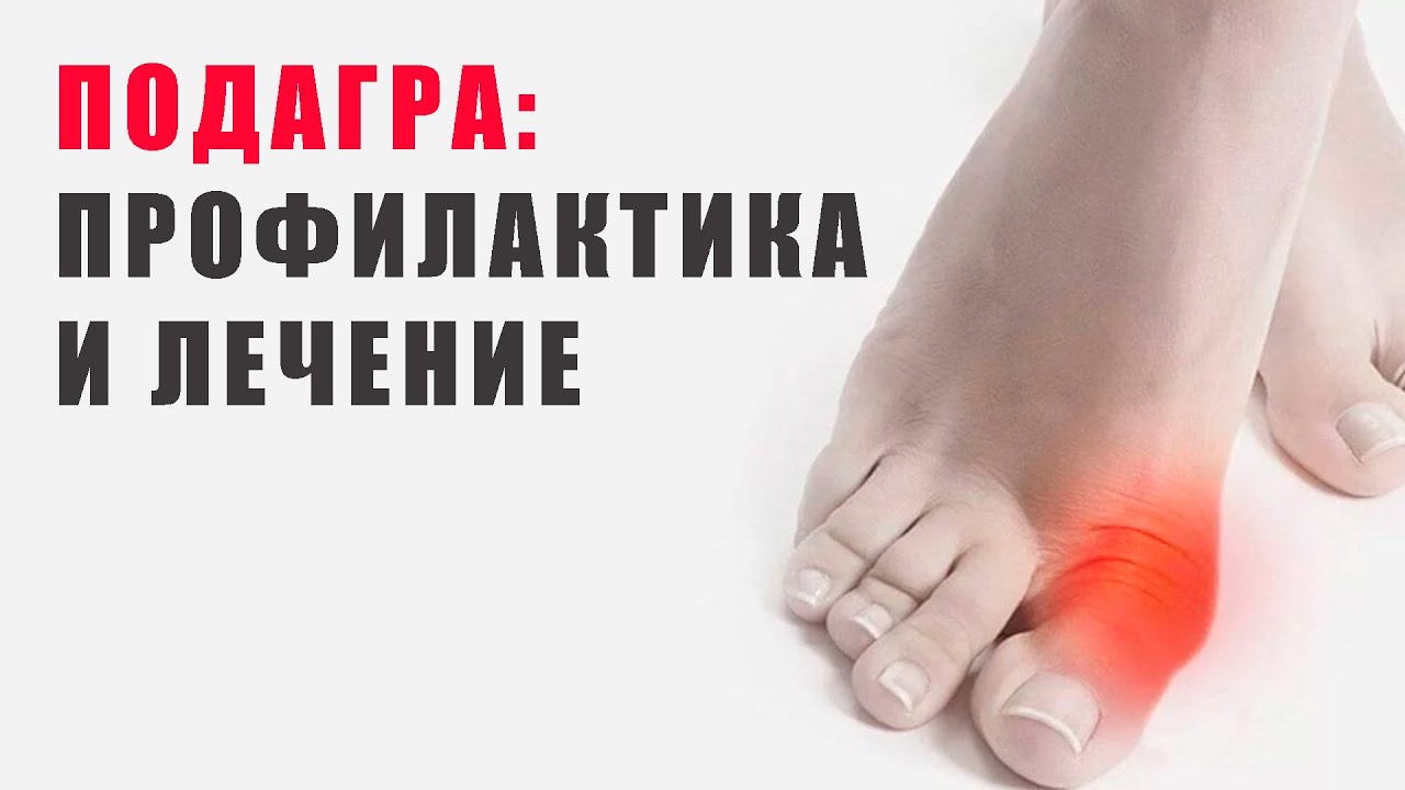 подагра в период обострения лечение
