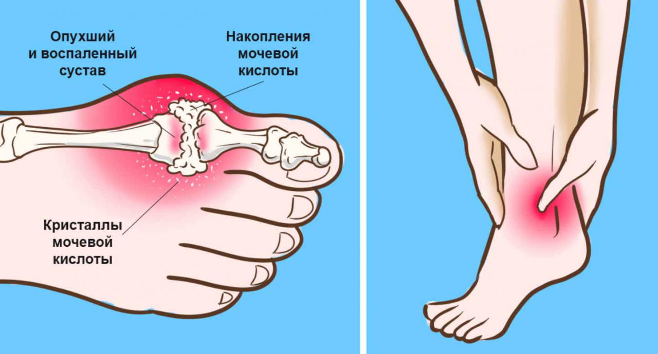 подагра в период обострения лечение