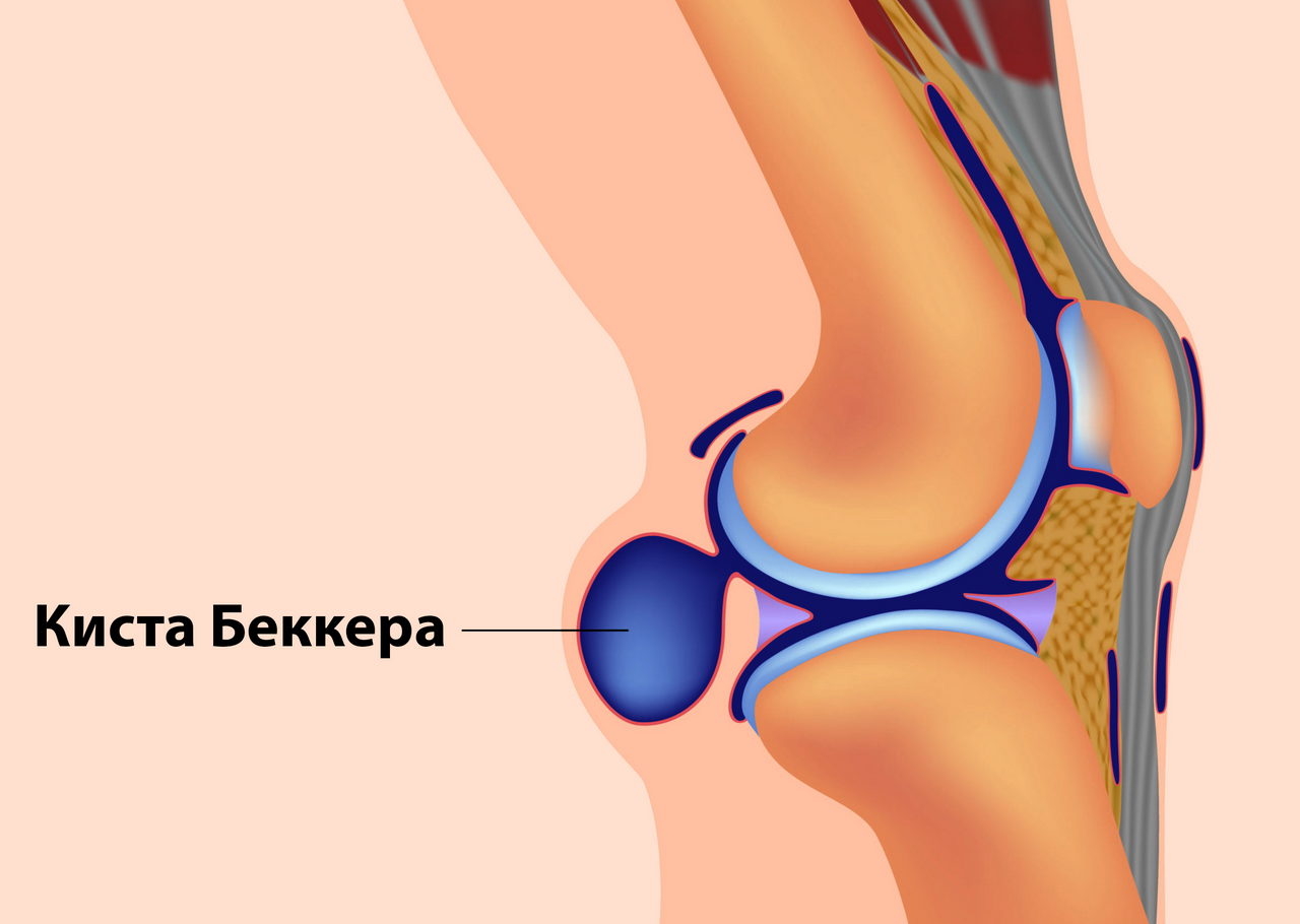 подколенная ямка болит подколенная ямка болит