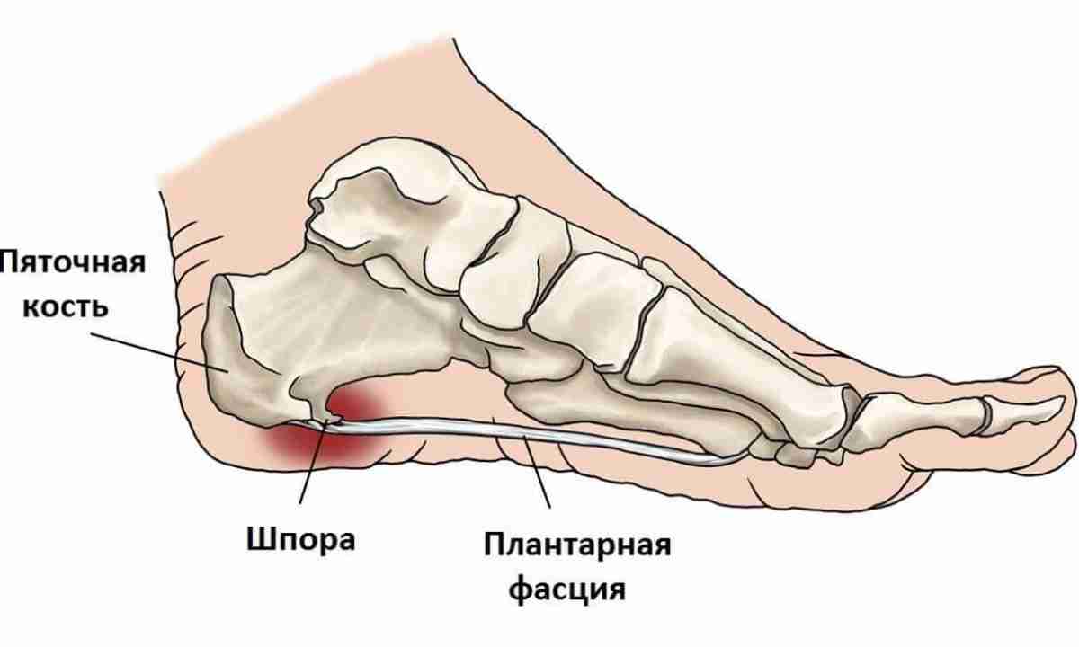 подошвенный тендиноз подошвенный тендиноз