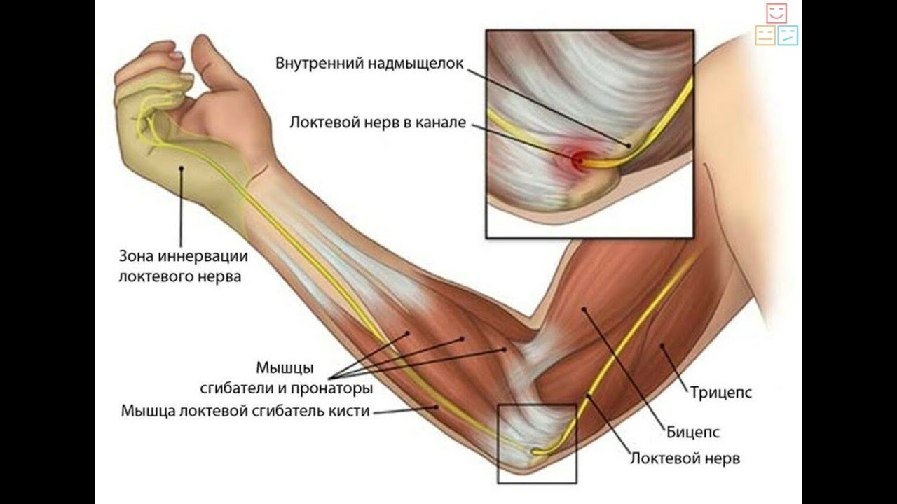 подострый эпикондилит лечение