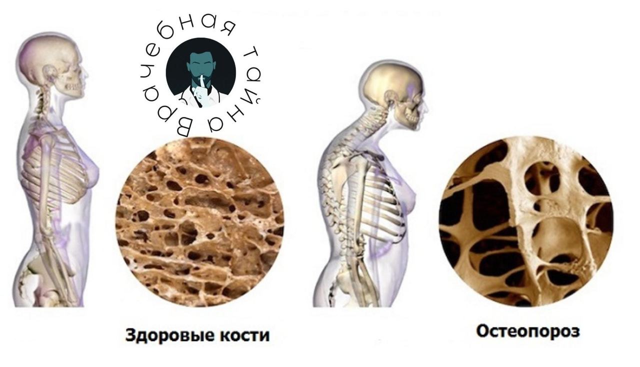 пороз костей пороз костей