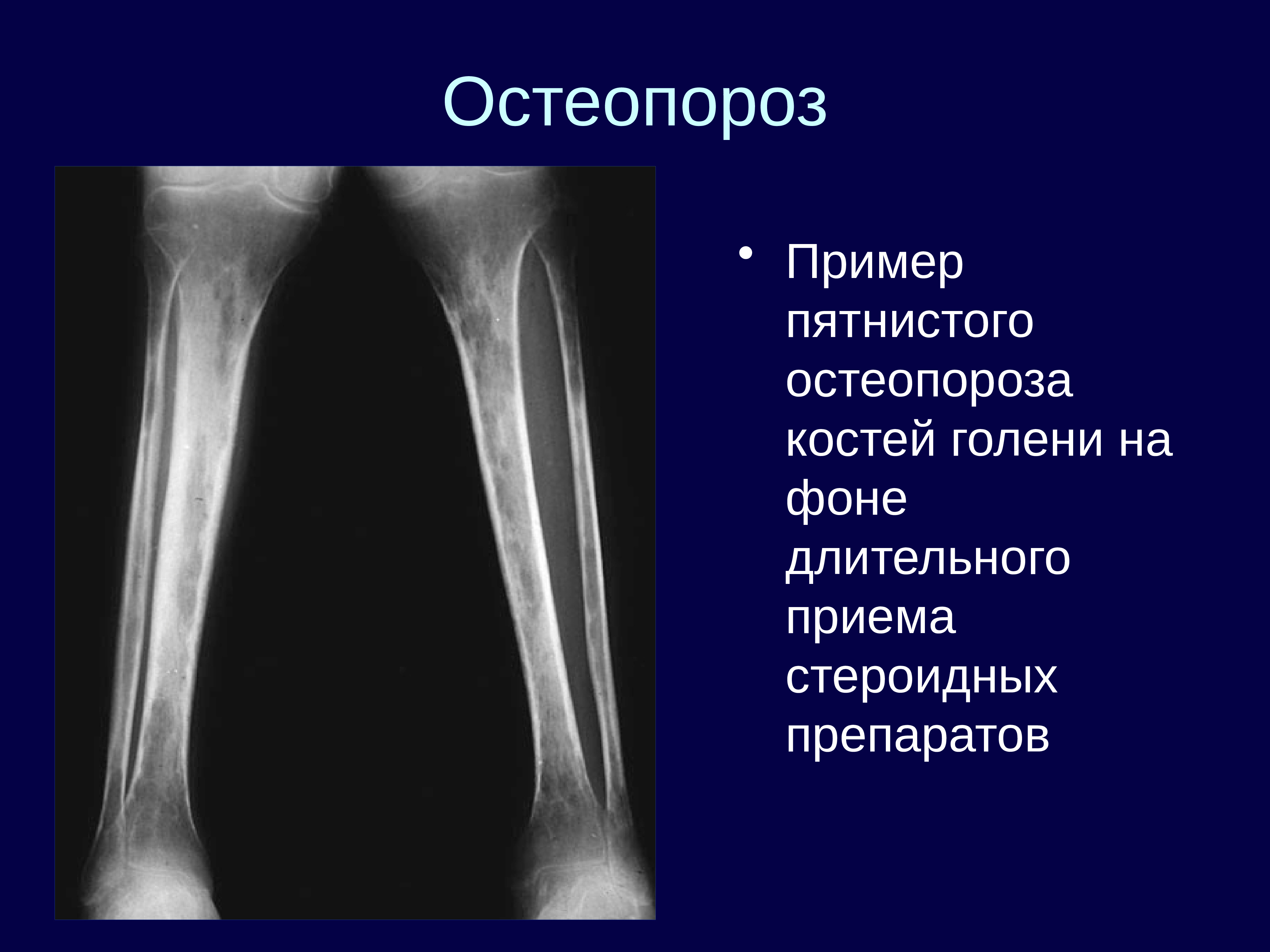 пороз костей