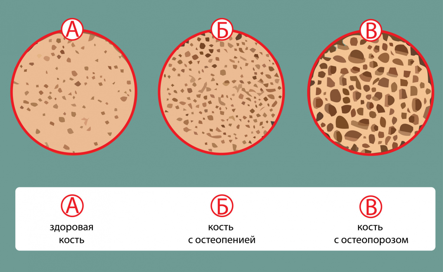 причины возникновения остеопороза у женщин