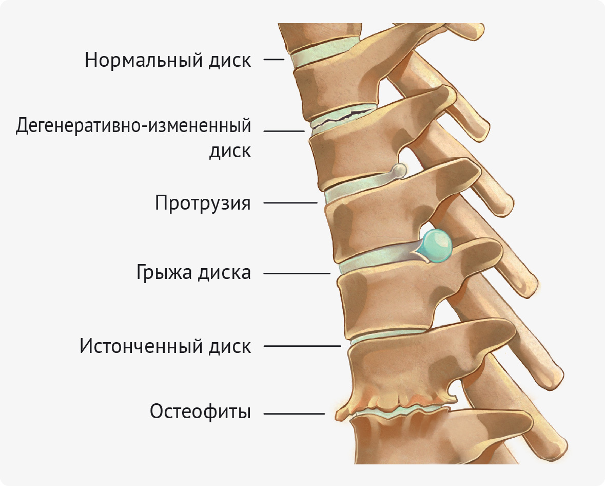 спондилез с5 с7 спондилез с5 с7