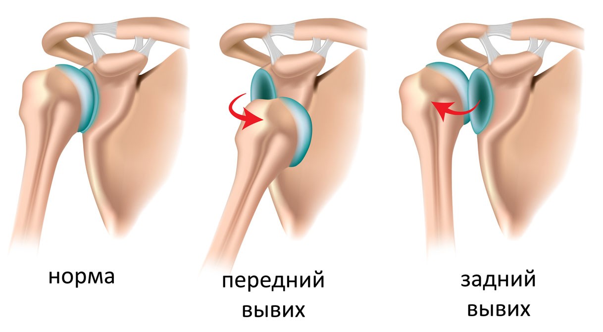 вывих колена симптомы вывих колена симптомы