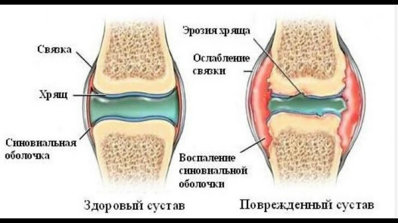 жидкость в коленном суставе причины симптомы