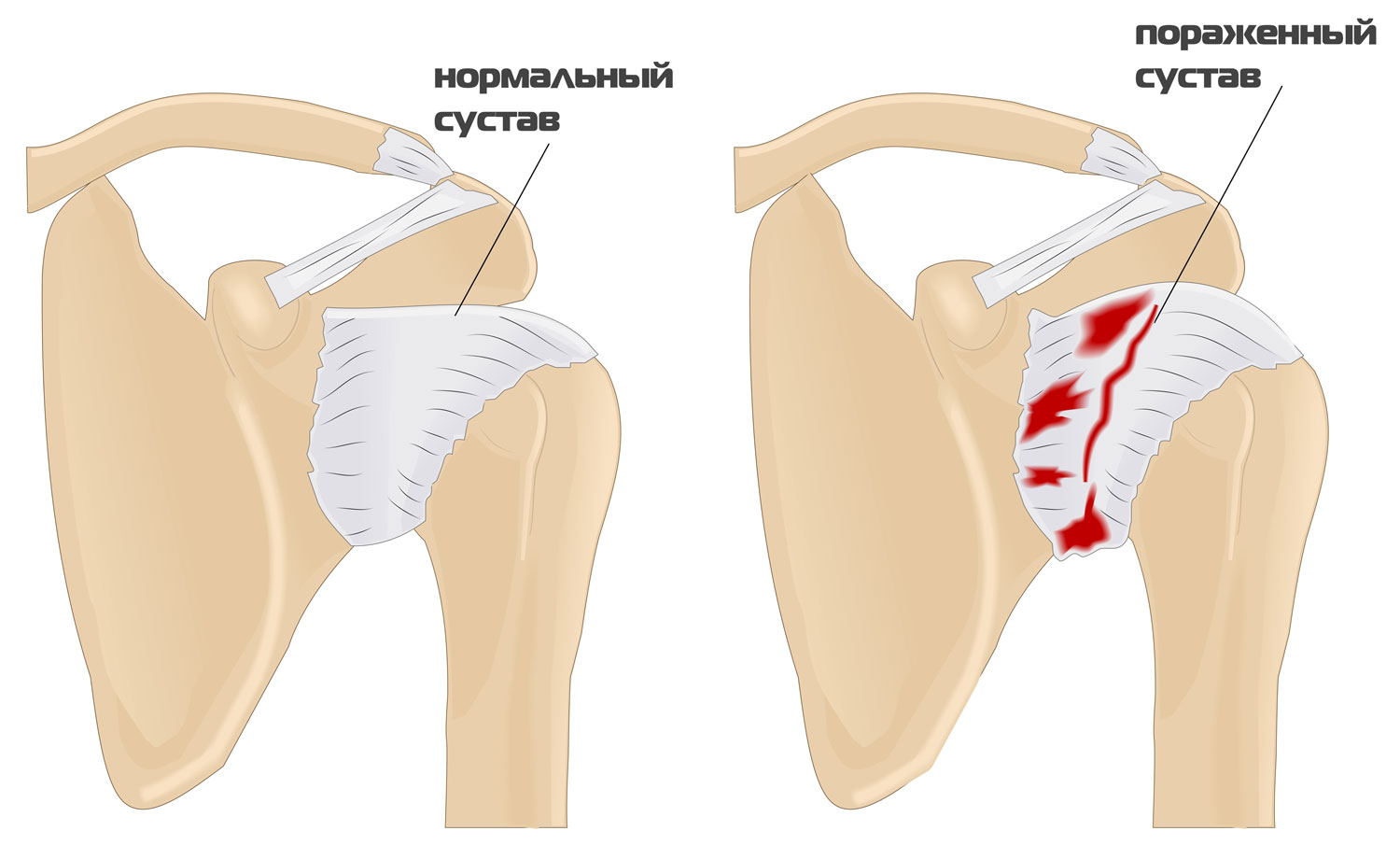 плечелопаточный синдром лечение