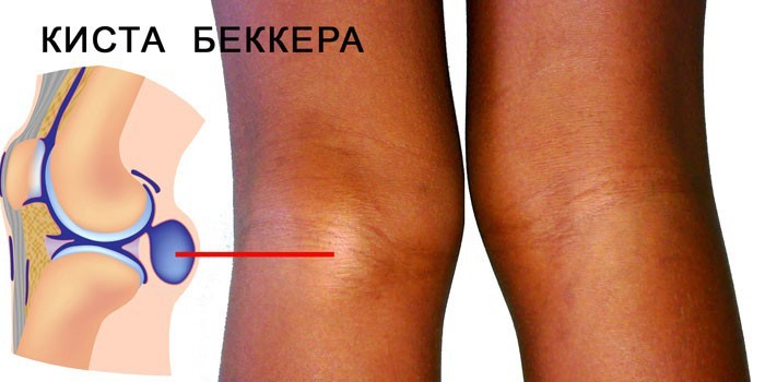 при сгибании в колене дискомфорт