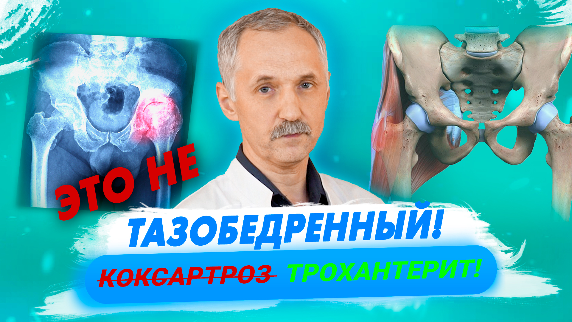 трохантерит воспаление бедренных сухожилий лечение трохантерит воспаление бедренных сухожилий лечение